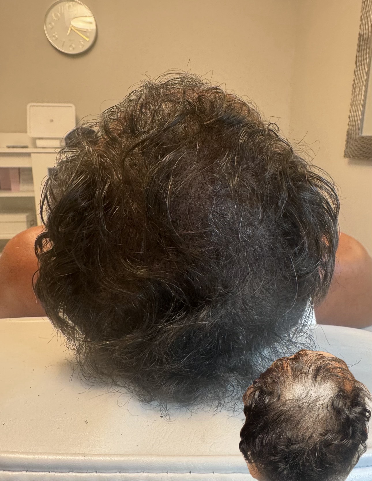 Crown density filled through thinning hair