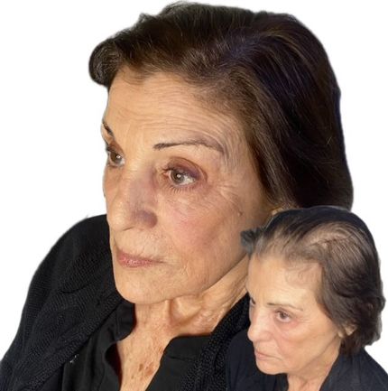 Softened hairline result for a mature female client